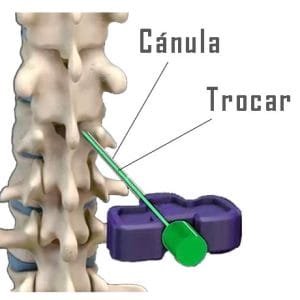Vértebra con cánula y trocar.