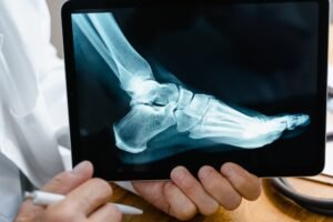Espolón Calcáneo: Causas, Prevención y Soporte Adecuado