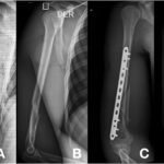 Placas LCP para Fracturas de Húmero