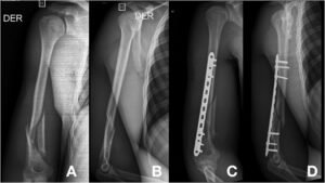 Placas LCP para Fracturas de Húmero