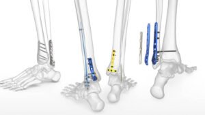 Placas LCP para Fracturas de Tibia y Peroné – Guía Completa 2025